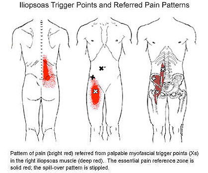 Iliopsoas Trigger Points and Referred Pain Patterns